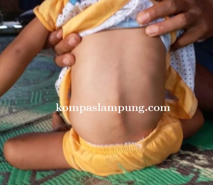 Rizka, Balita Yang Butuh Bantuan Dari Pemda Lampung Timur Dan Para Darmawan